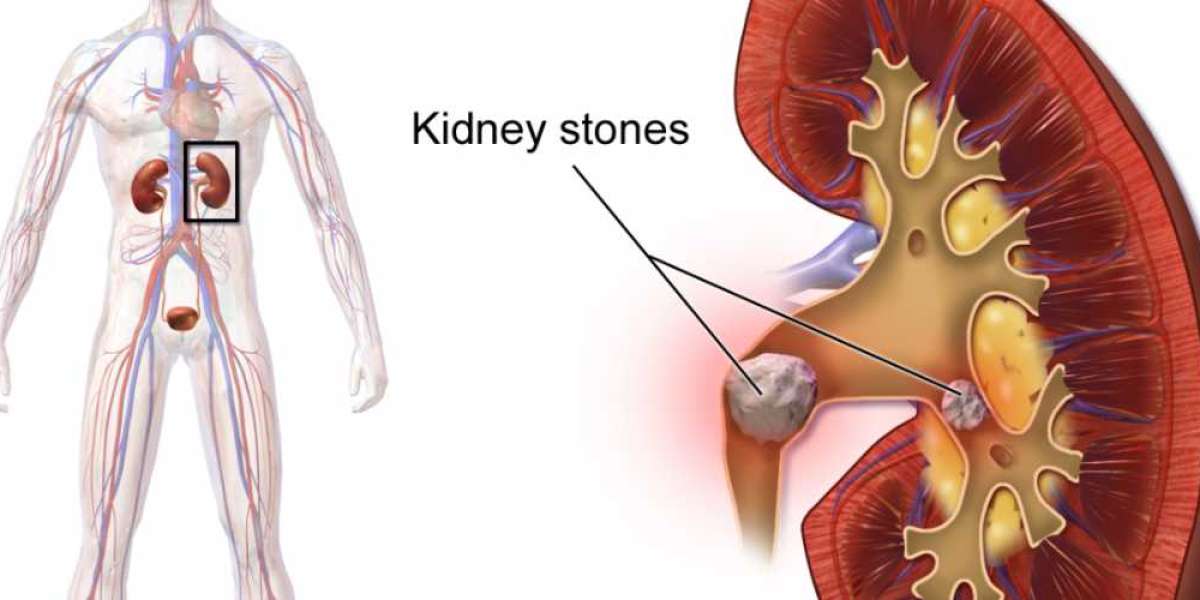 Best Kidney Stone Removal Hospital in Noida